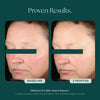 Before and after comparison of woman's face in clinical study with Marini Reboot PDRN Face Serum by Marini SkinSolutions: PDRN plus advanced rejuvenating technologies, for enhanced regeneration and rejuvenation in a single serum. Support recovery, resilience, and long-term skin health for visibly smoother, younger looking skin.