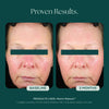 Before and after skin treatment results using Marini Reboot PDRN Face Serum. These proven results show anti-aging, skin longevity, skin regeneration, and overall better skin health.