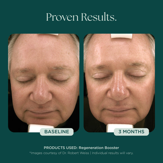 Before and after comparison of a man's face after using medical grade skin care from Marini SkinSolutions. His anti-aging results were from 3 months of the patented and clinically proven Regeneration Booster face serum.