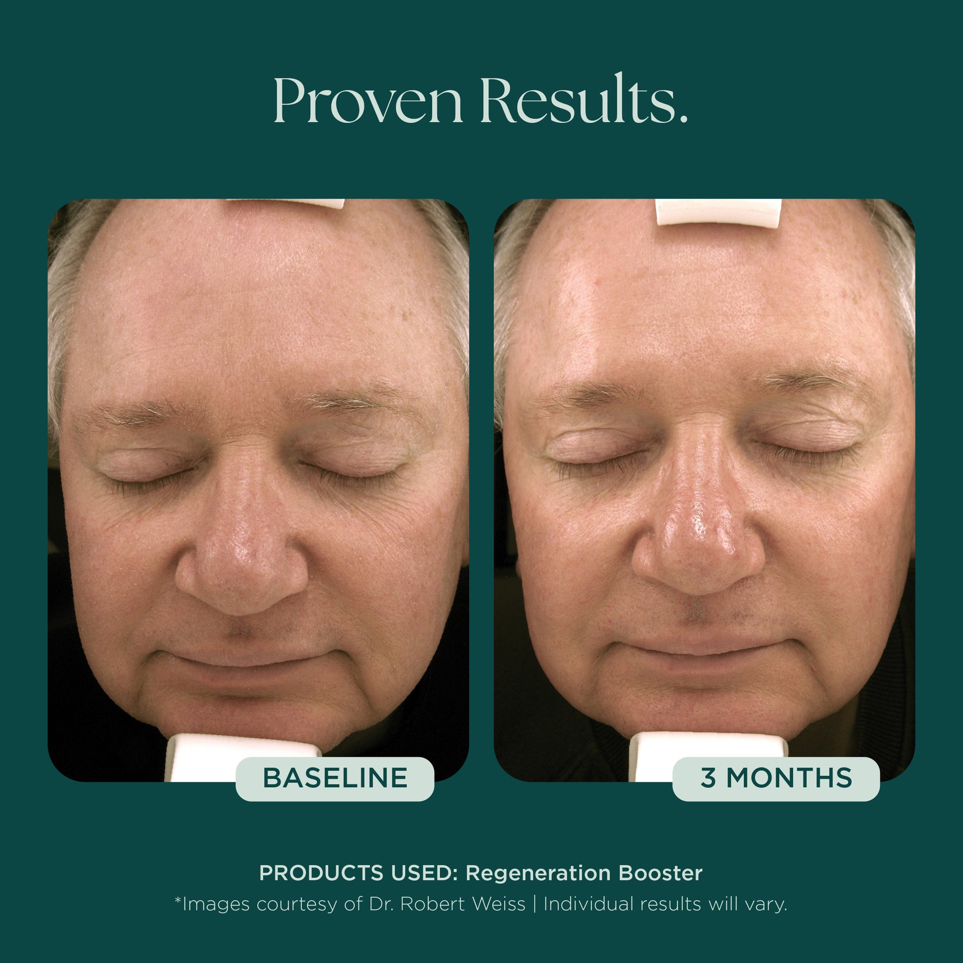 Before and after comparison of a man's face after using medical grade skin care from Marini SkinSolutions. His anti-aging results were from 3 months of the patented and clinically proven Regeneration Booster face serum.