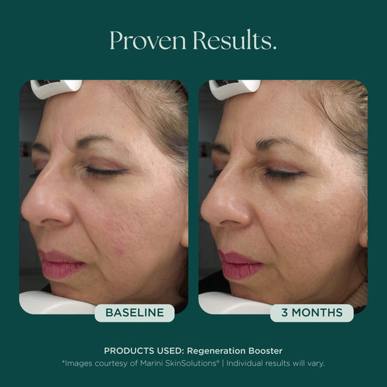 Before and after comparison of a woman's face with visible results of anti-aging and skin quality in 3 months using Regeneration Booster face serum from Marini SkinSolutions.