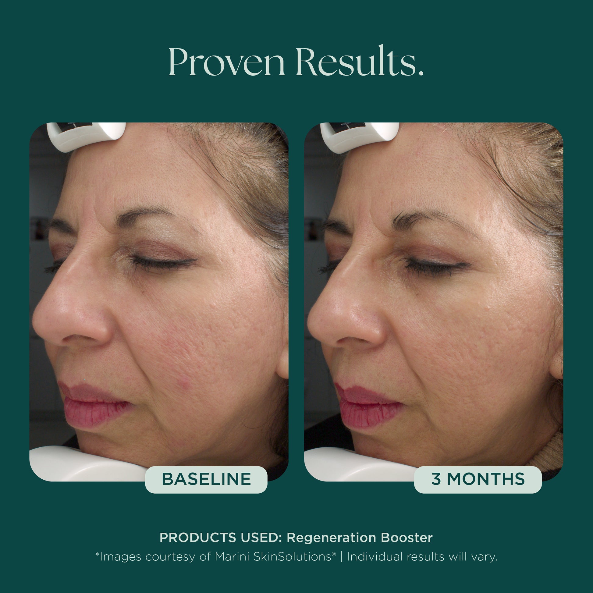 Before and after comparison of a woman's face with visible results of anti-aging and skin quality in 3 months using Regeneration Booster face serum from Marini SkinSolutions.