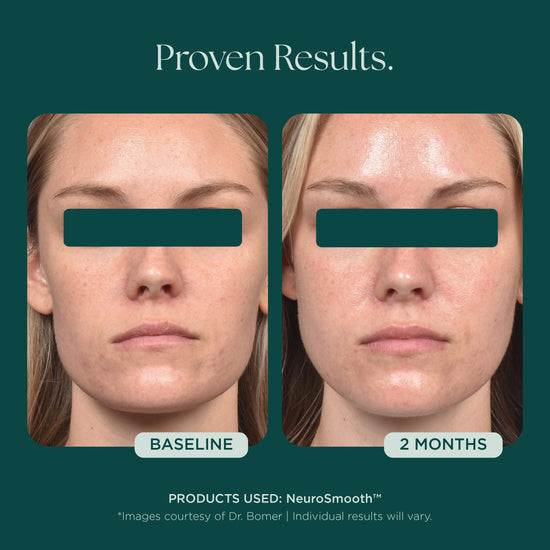 Before and after comparison of a woman's face with 'NeuroSmooth' product, showing 'Baseline' and '2 Months' results. NeuroSmooth is a neruromodulating peptide face serum for glass smooth skin.