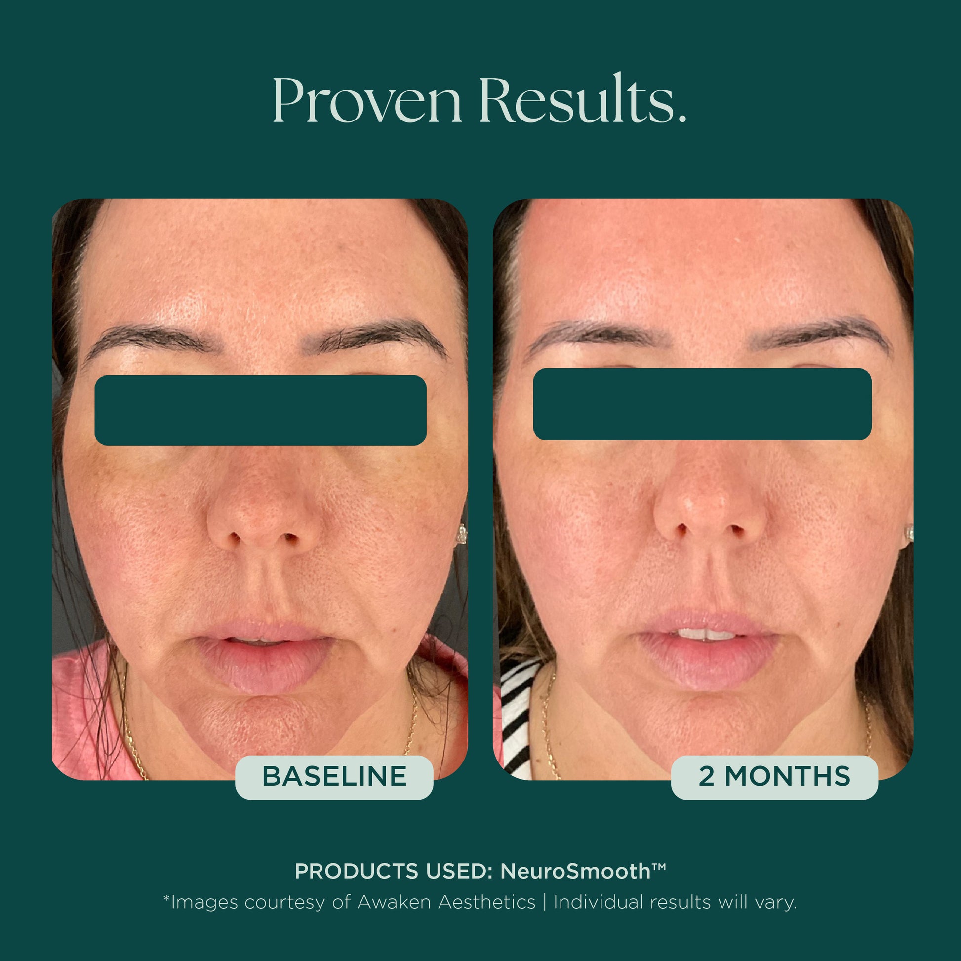 Before and after comparison of a glass skin clinical study showing visible and proven results. The patient used NeuroSmooth, an award-winning face serum for glass smooth skin.