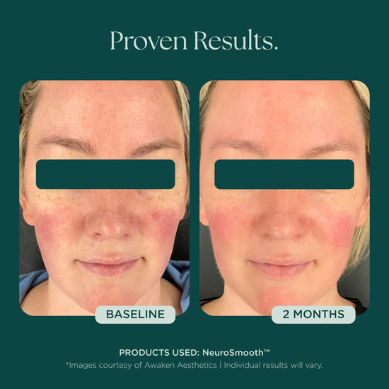 Before and after comparison of a person's face showing visible skin improvement in redness, complexion, smoothness, and overall skin quality. This person uses NeuroSmooth by Marini SkinSolutions to achieve glass skin.