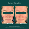 Before and after comparison of a person's face showing visible skin improvement in redness, complexion, smoothness, and overall skin quality. This person uses NeuroSmooth by Marini SkinSolutions to achieve glass skin.