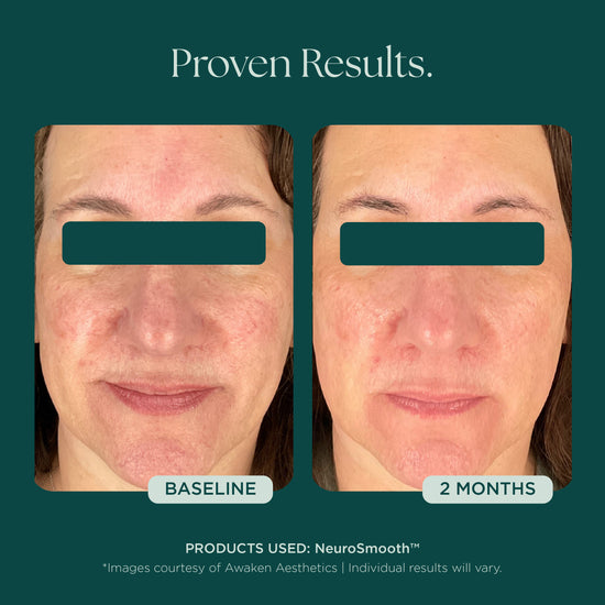 Before and after comparison of a woman's face with 'NeuroSmooth' face serum, an award-winning anti-aging skin care product by Marini SkinSolutions.