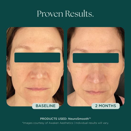 Before and after comparison of a woman's face with visible anti-aging results using NeuroSmooth - a first of it's kind glass skin face serum by Marini SkinSolutions.