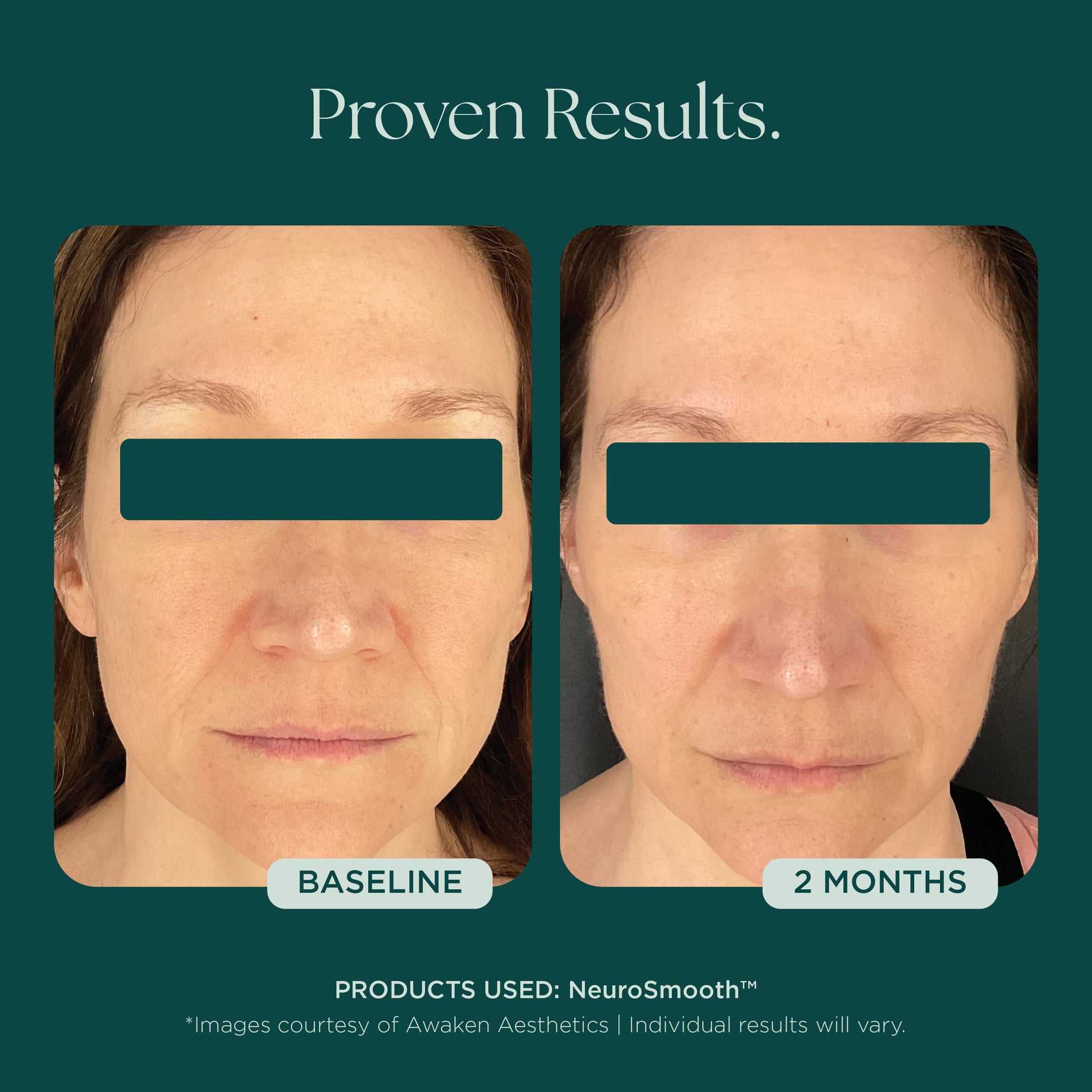 Before and after comparison of a woman's face with visible anti-aging results using NeuroSmooth - a first of it's kind glass skin face serum by Marini SkinSolutions.