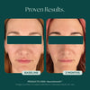 Before and after comparison of a woman's face showing glass skin after 2 months of use of NeuroSmooth, a face serum with neuromodulating peptides for glass skin and small pores.