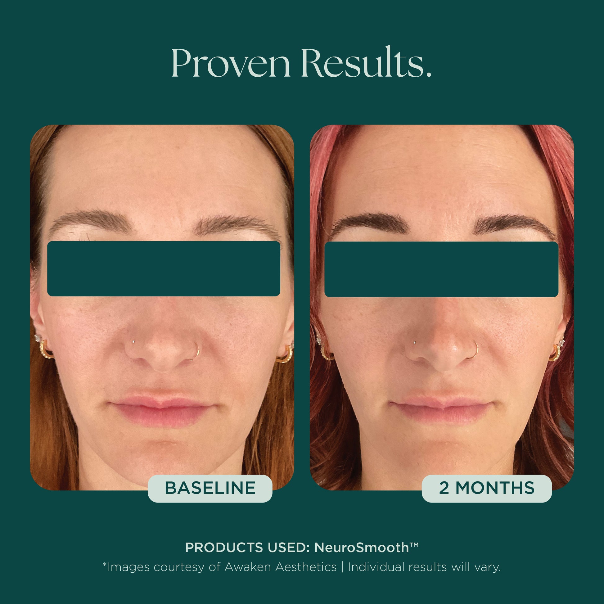 Before and after comparison of a woman's face showing glass skin after 2 months of use of NeuroSmooth, a face serum with neuromodulating peptides for glass skin and small pores.