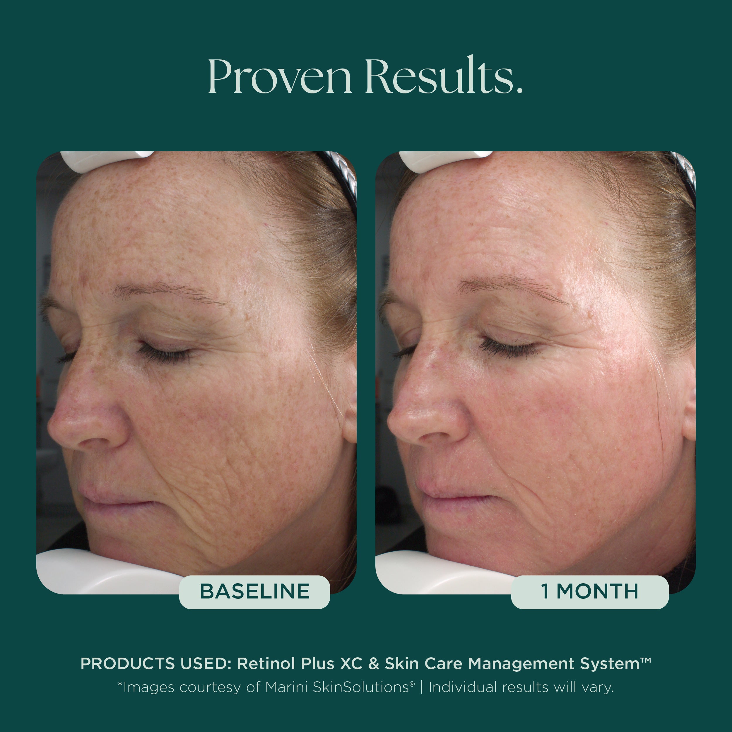 Retinol Plus XC | Clinically Proven Award-Winning Retinol Face