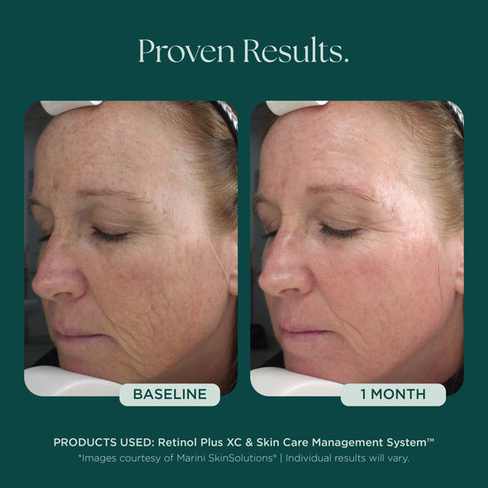 Retinol Plus skin care before and after showing results in as little as 1 month. Twice awarded Best Retinol Cream by NewBeauty Magazine! Marini SkinSolutions retinol face cream blends potent retinol and peptides with green tea extract, chrysin, bisabolol, and hyaluronic acid for unparalleled results and satisfaction.