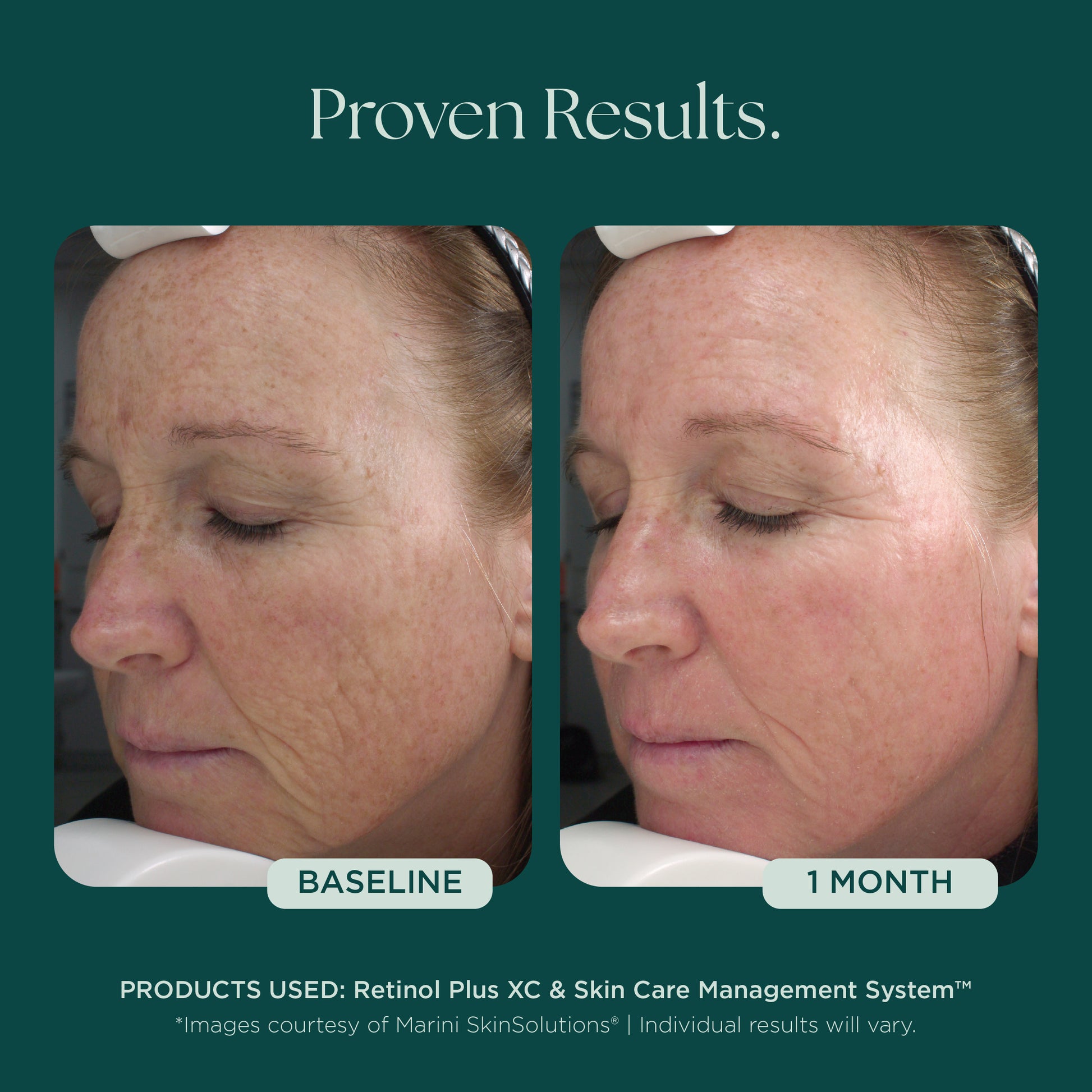 Retinol Plus skin care before and after showing results in as little as 1 month. Twice awarded Best Retinol Cream by NewBeauty Magazine! Marini SkinSolutions retinol face cream blends potent retinol and peptides with green tea extract, chrysin, bisabolol, and hyaluronic acid for unparalleled results and satisfaction.