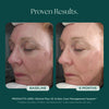Visible anti-aging results with only 6 months from baseline from a before and after comparison of woman's face. She consistently used Retinol Plus face cream from Marini SkinSolutions that reduces the appearance of wrinkles and fine lines. 