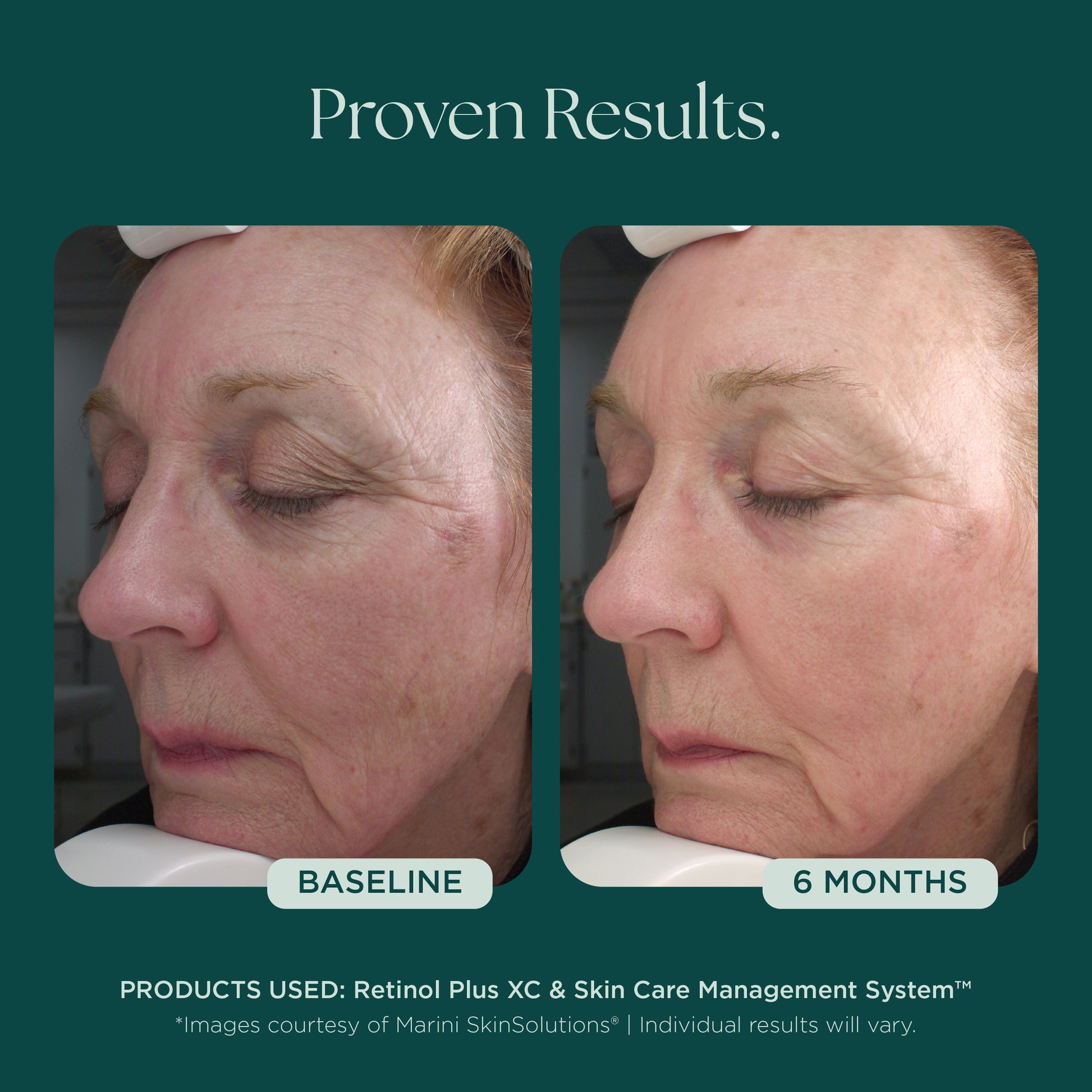 Visible anti-aging results with only 6 months from baseline from a before and after comparison of woman's face. She consistently used Retinol Plus face cream from Marini SkinSolutions that reduces the appearance of wrinkles and fine lines. 