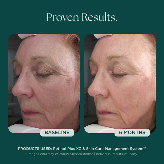 Visible anti-aging results with only 6 months from baseline from a before and after comparison of woman's face. She consistently used Retinol Plus face cream from Marini SkinSolutions that reduces the appearance of wrinkles and fine lines. 