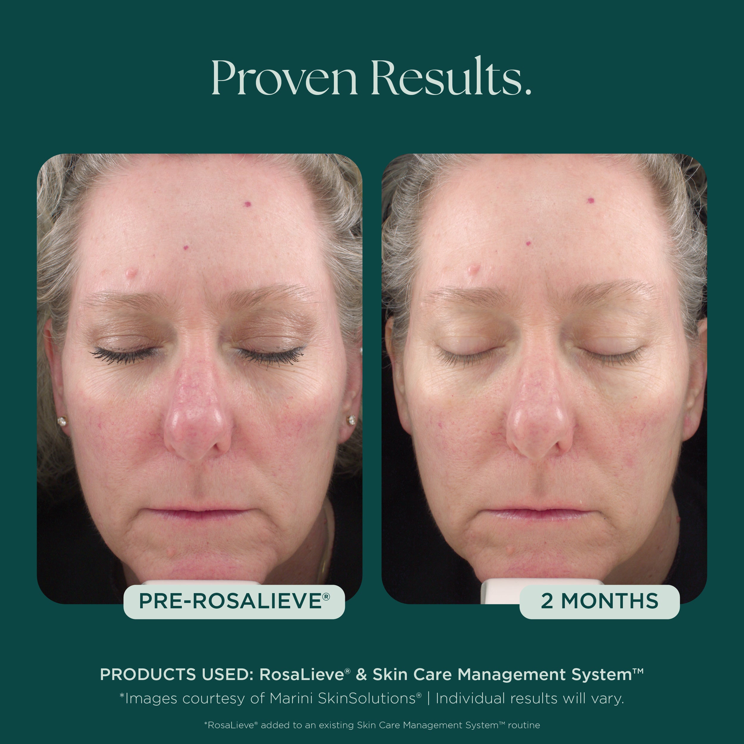 RosaLieve® | Reduce Face Redness with Clinically Proven Skin Care