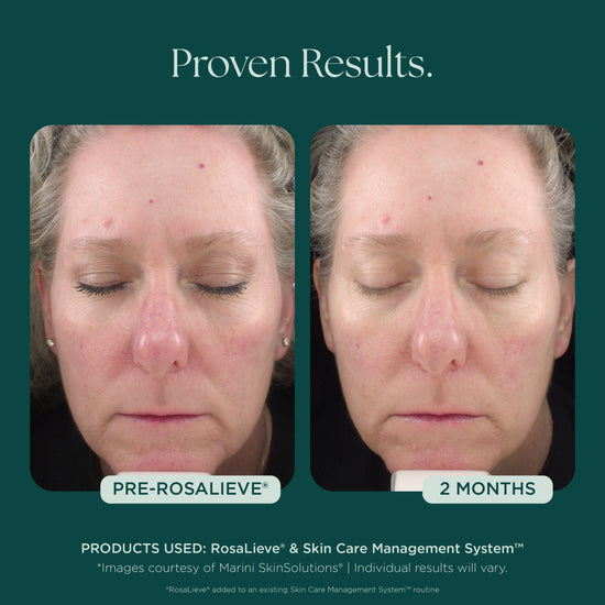 Before and After Clinical Study on Reducing Face Redness with Medical Grade Skin Care Product: RosaLieve Redness Reducing Complex from Marini SkinSolutions. 