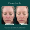 Before and After Clinical Study on Reducing Face Redness with Medical Grade Skin Care Product: RosaLieve Redness Reducing Complex from Marini SkinSolutions. 