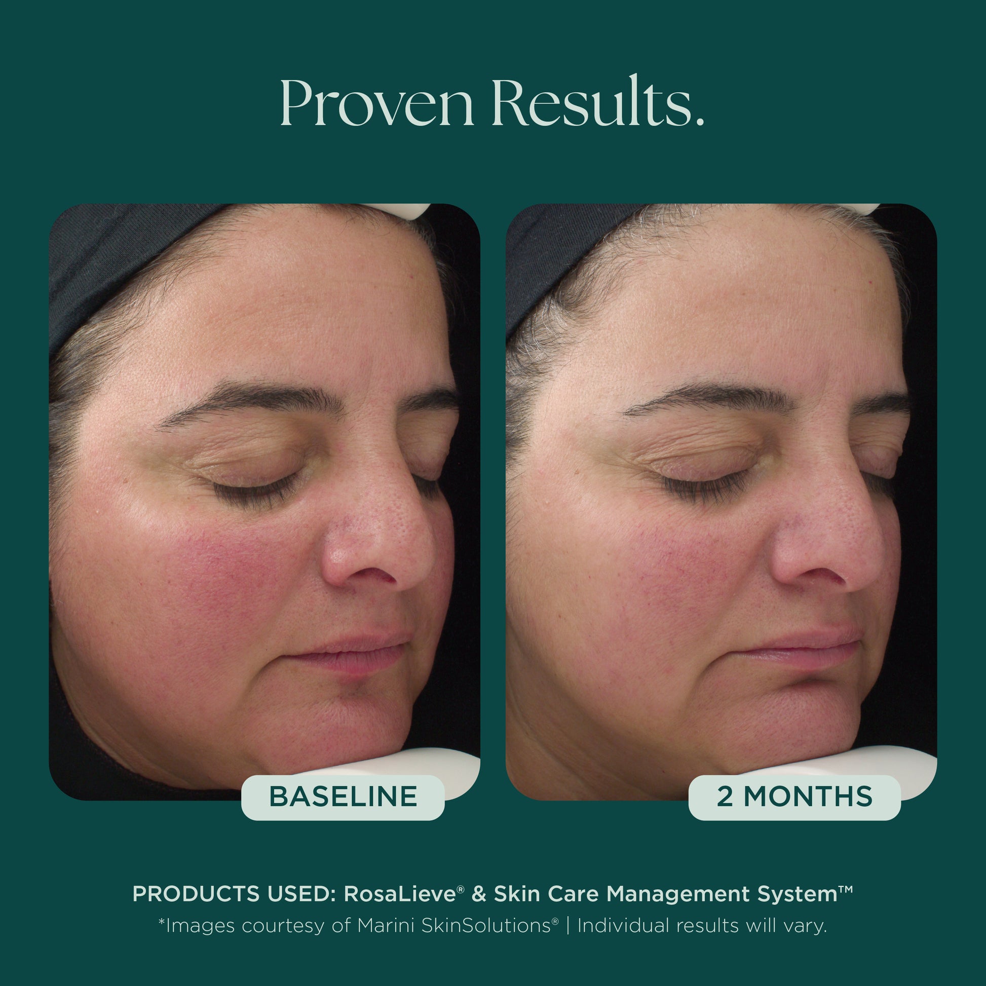 Before and After Clinical Study on Reducing Face Redness with Medical Grade Skin Care Product: RosaLieve Redness Reducing Complex from Marini SkinSolutions. 