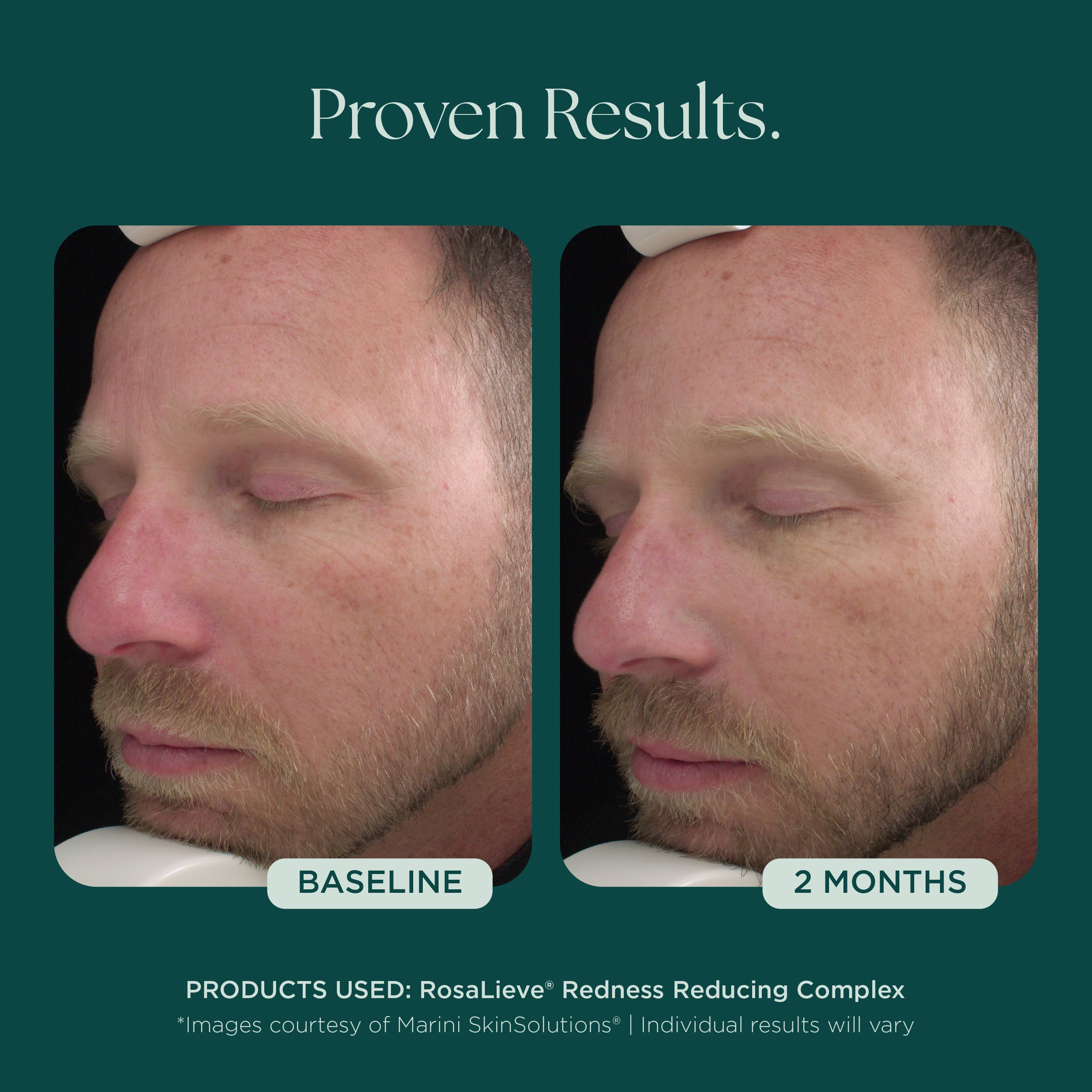 RosaLieve® | Reduce Face Redness with Clinically Proven Skin Care