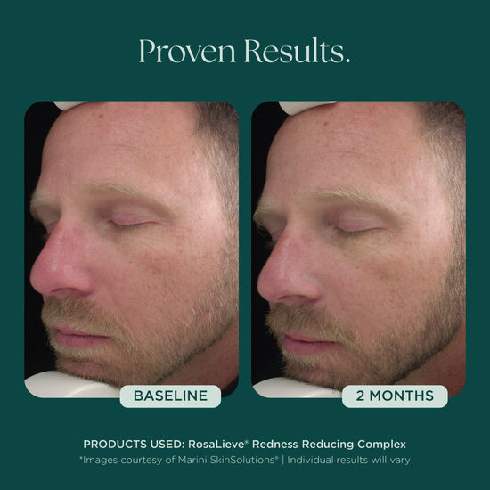 Before and After Clinical Study on Reducing Face Redness with Medical Grade Skin Care Product: RosaLieve Redness Reducing Complex from Marini SkinSolutions. 
