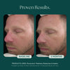 Before and After Clinical Study on Reducing Face Redness with Medical Grade Skin Care Product: RosaLieve Redness Reducing Complex from Marini SkinSolutions. 