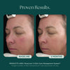 Before and After Clinical Study on Reducing Face Redness with Medical Grade Skin Care Product: RosaLieve Redness Reducing Complex from Marini SkinSolutions. 