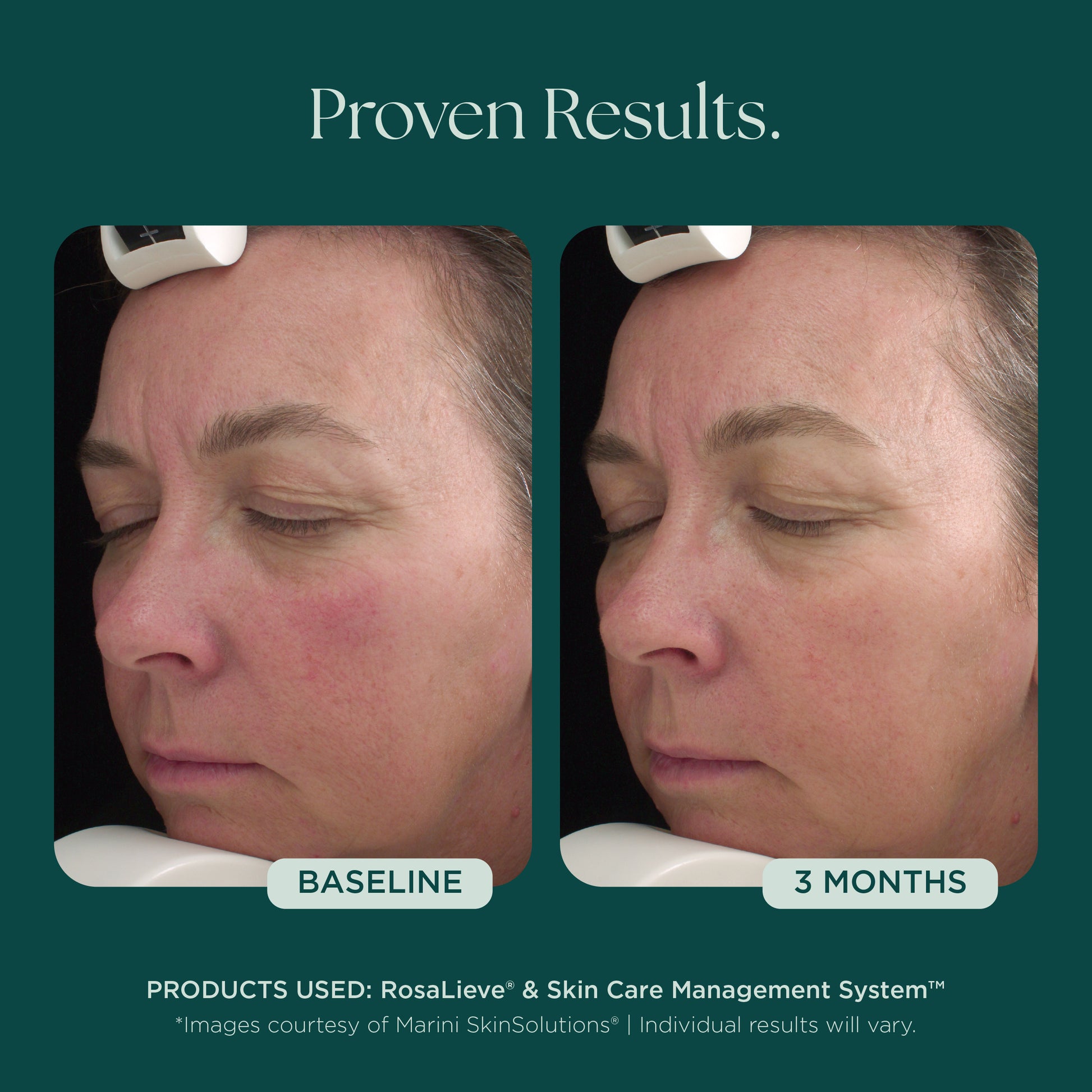 Before and After Clinical Study on Reducing Face Redness with Medical Grade Skin Care Product: RosaLieve Redness Reducing Complex from Marini SkinSolutions. 