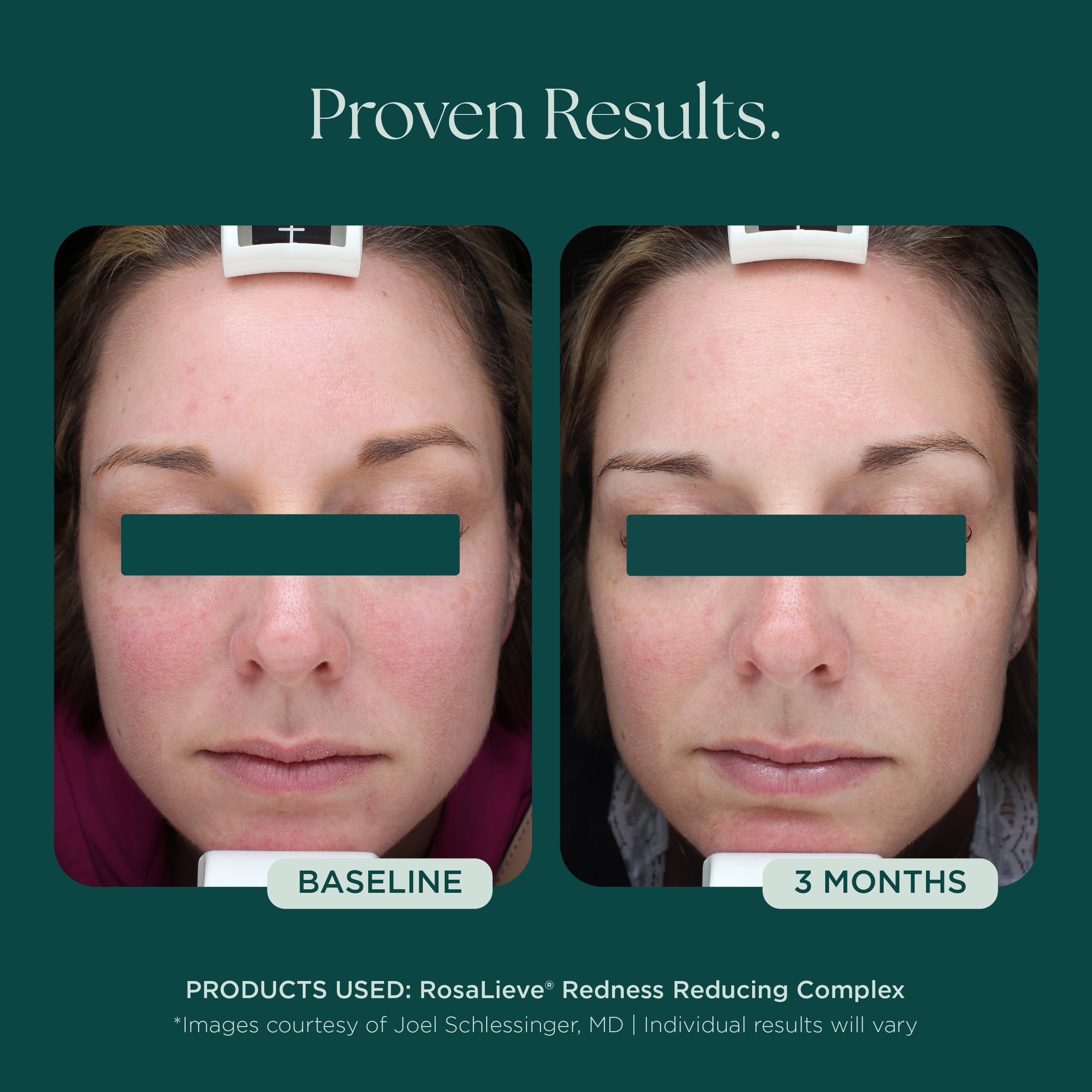 RosaLieve® | Reduce Face Redness with Clinically Proven Skin Care