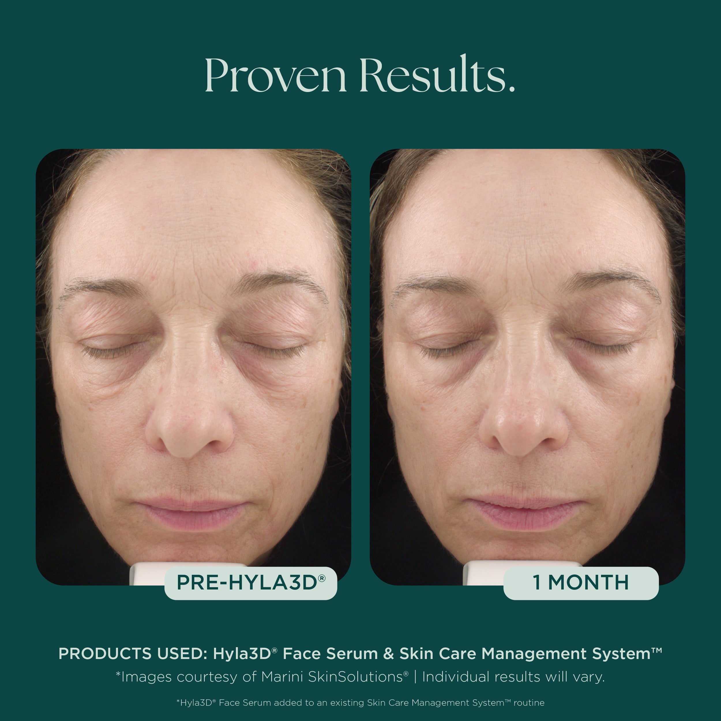 Hyla3D® Face Serum | Hyaluronic Acid HA | Facial Volume