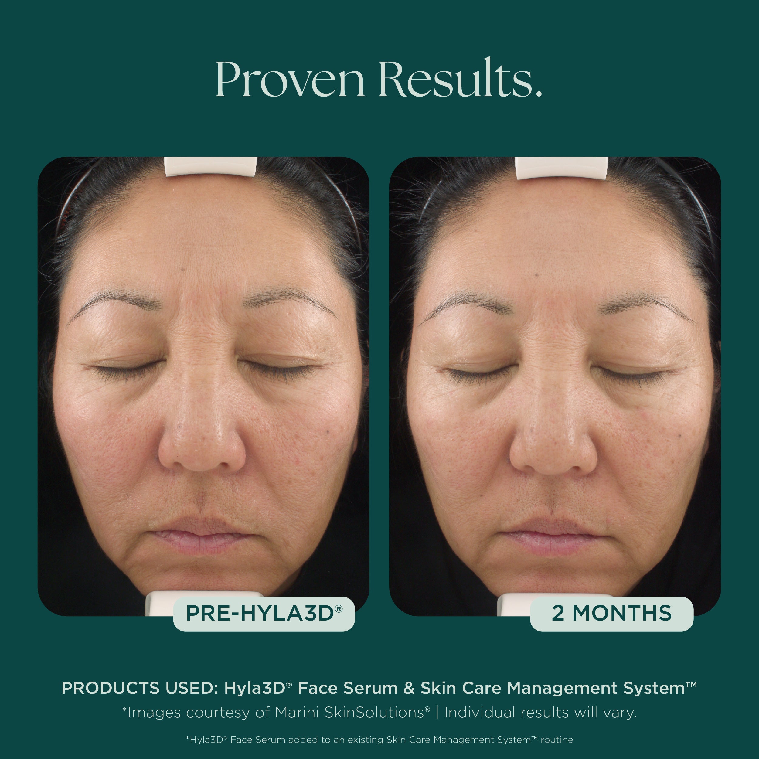 Hyla3D® Face Serum | Hyaluronic Acid HA | Facial Volume